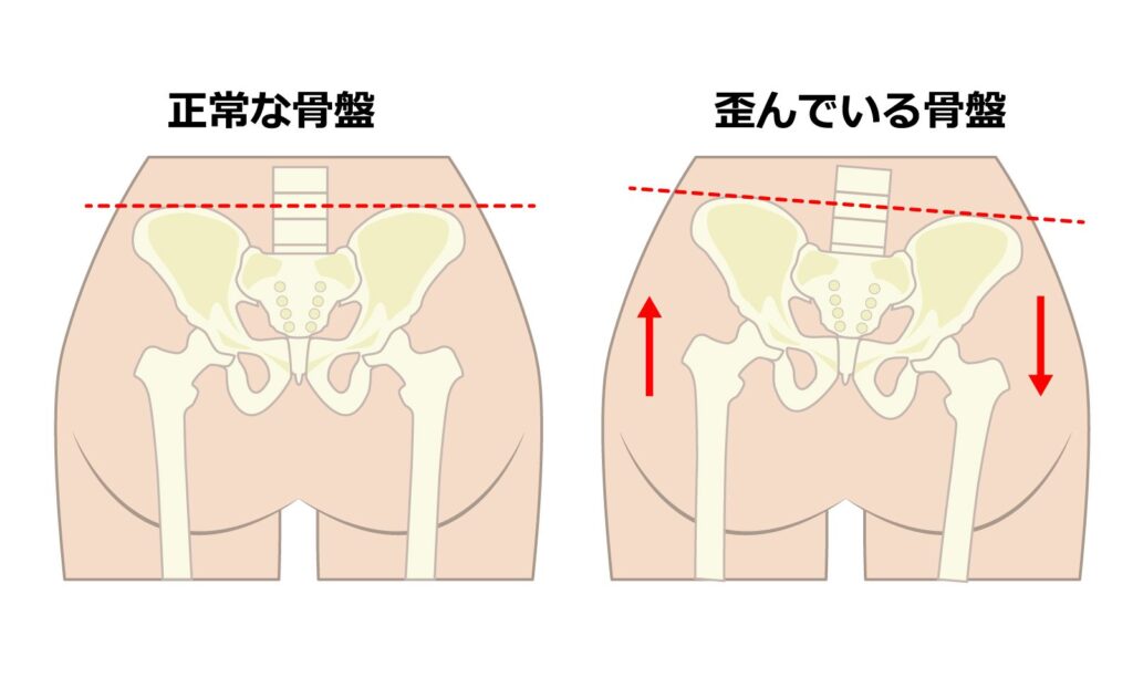 正常な骨盤・歪んでる骨盤