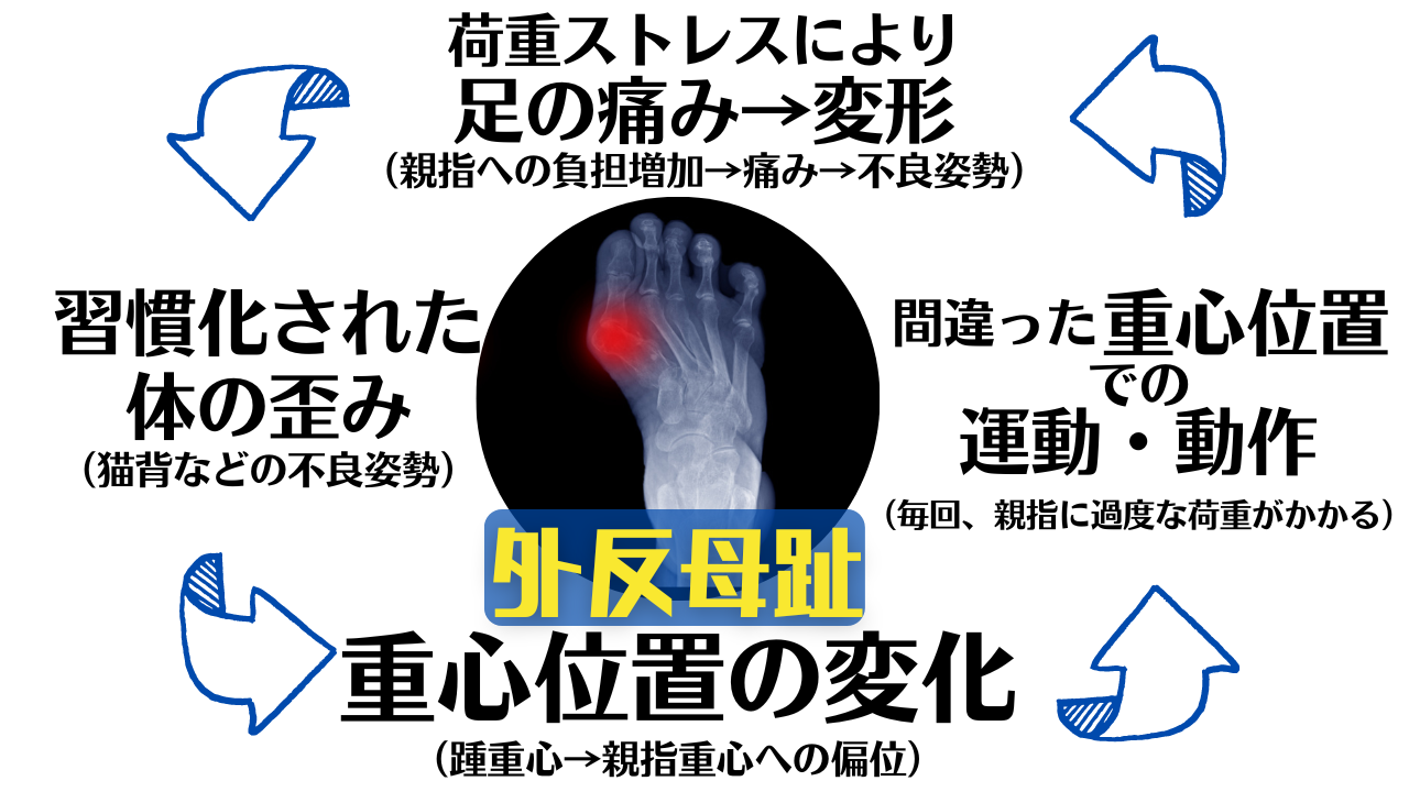 体の歪みと日常生活動作の悪い癖を矯正しないと外反母趾は良くなりません