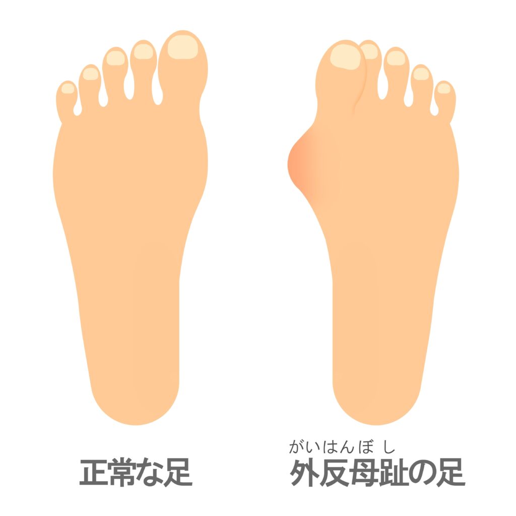 正常な足と外反母趾の足