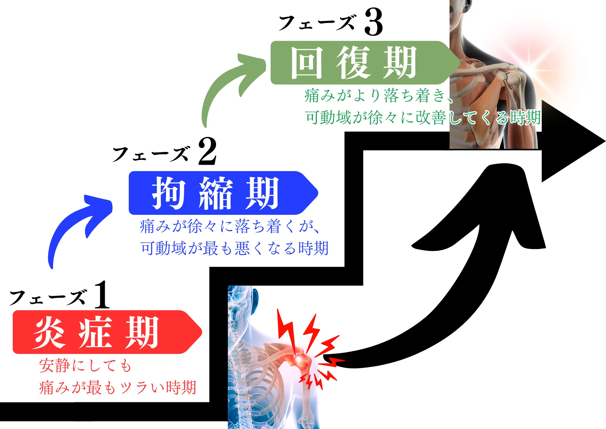 肩関節のフェーズと改善チャートの図